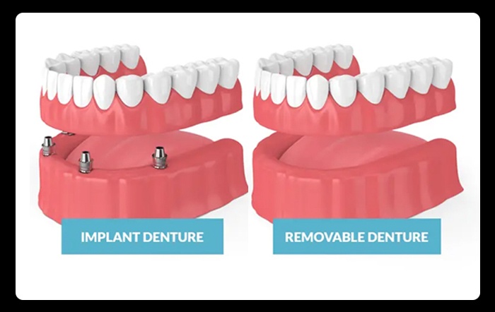 Denture Types and Benefits